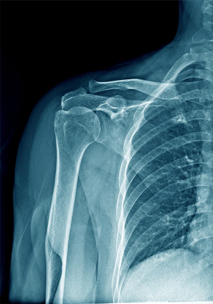 Chirurgia della spalla